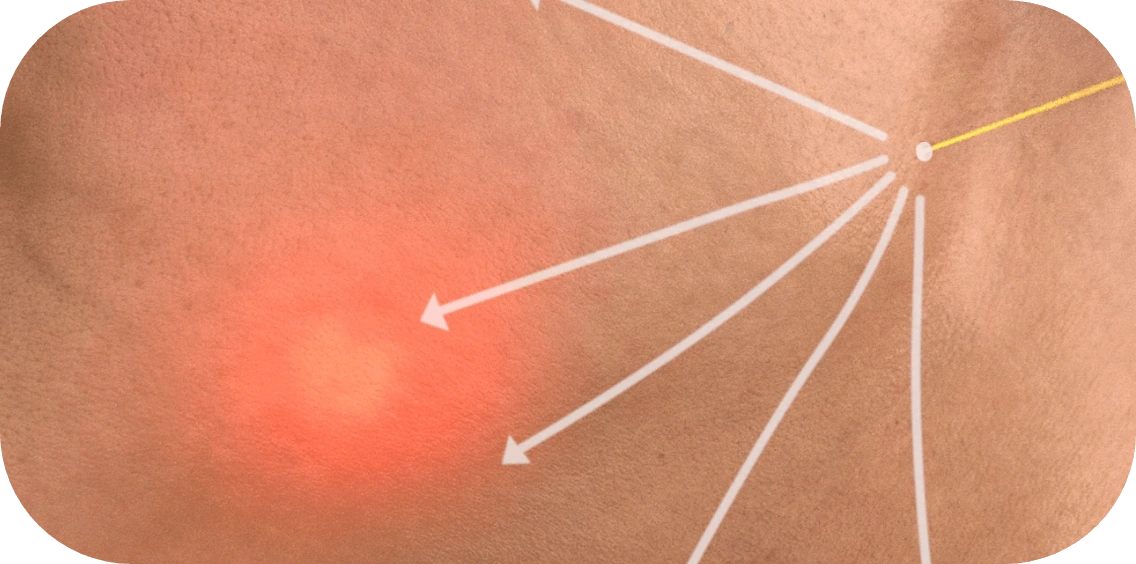 EndoliftX laser treatment fiber insertion step