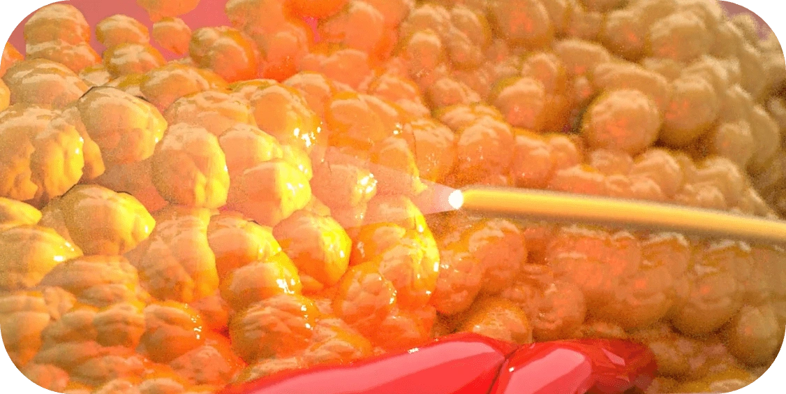 Endolift laser stimulating collagen for tighter, smoother skin