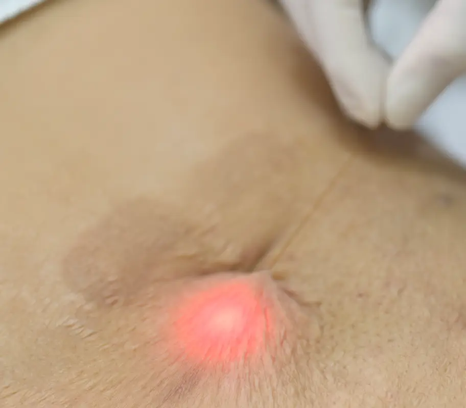 Endolift laser body tightening treatment