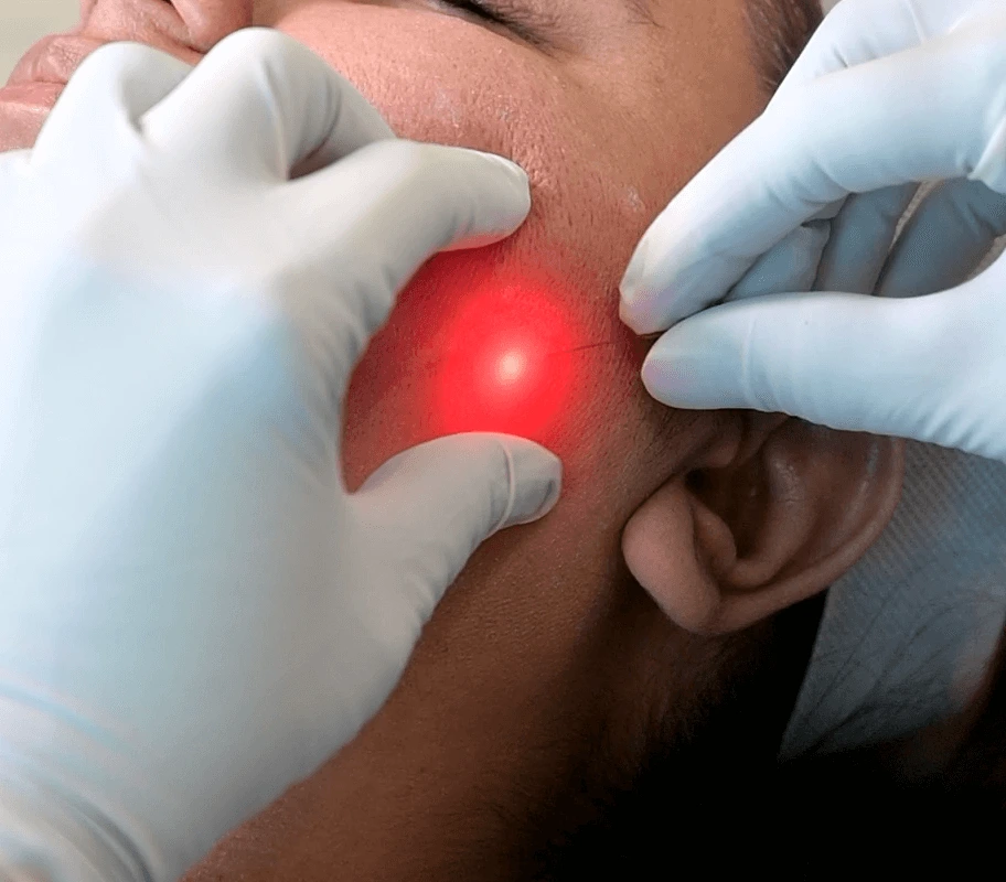 Endolift skin tightening