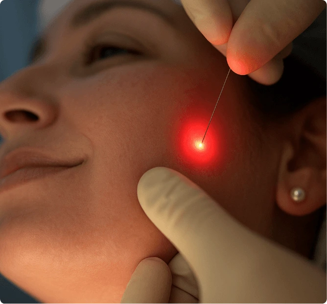 Endolift laser facelift treatment