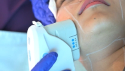 Ultherapy Prime targeted energy placement treatment