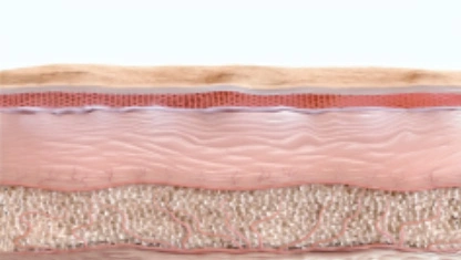 Natural collagen rebuild after Ultherapy Prime