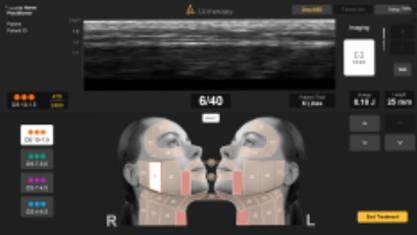 Ultherapy Prime real-time ultrasound skin mapping