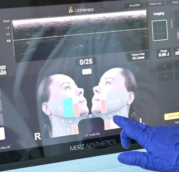 Ultherapy Prime real-time ultrasound imaging screen